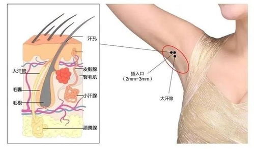 狐臭是怎么产生的 到底是疾病还是生理现象,该怎么根除